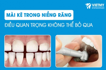 Mài Kẽ Răng Trong Niềng: Điều Quan Trọng Mà Bạn Không Nên Bỏ Qua